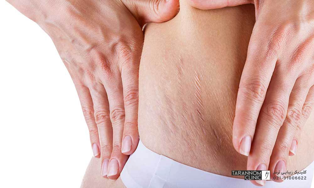 Perle et Soie علل ایجاد ترکهای پوستی یا استرچ مارکها