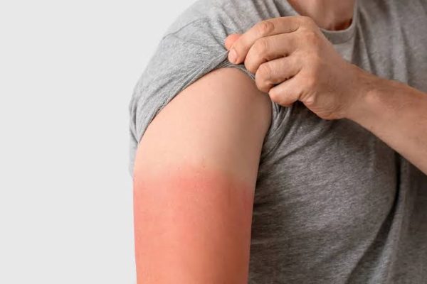 ۱۰ اشتباه رایج که عوارض آفتاب سوختگی را تشدید میکنند